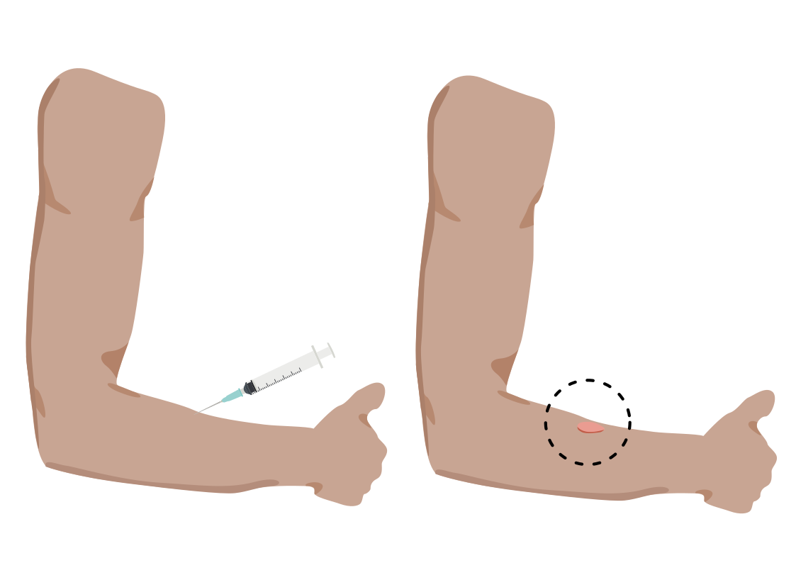 Illustration showing intradermal allergen testing on the forearm 