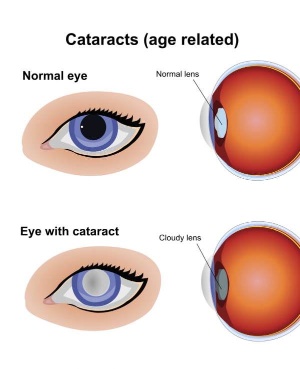 Illustration that shows normal eye and normal lens vs eye with cataract and cloudy lens