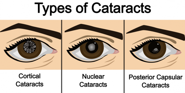 Illustration of types of cataracts - cortical cataracts, nuclear cataracts and posterior capsular cataracts