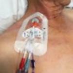 Ports and Catheters in Cancer Treatment